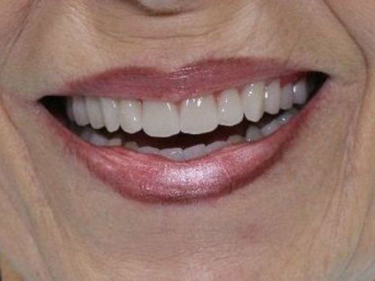 Dentures: Case 2 — after