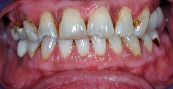 Veneers: Case 12 — before