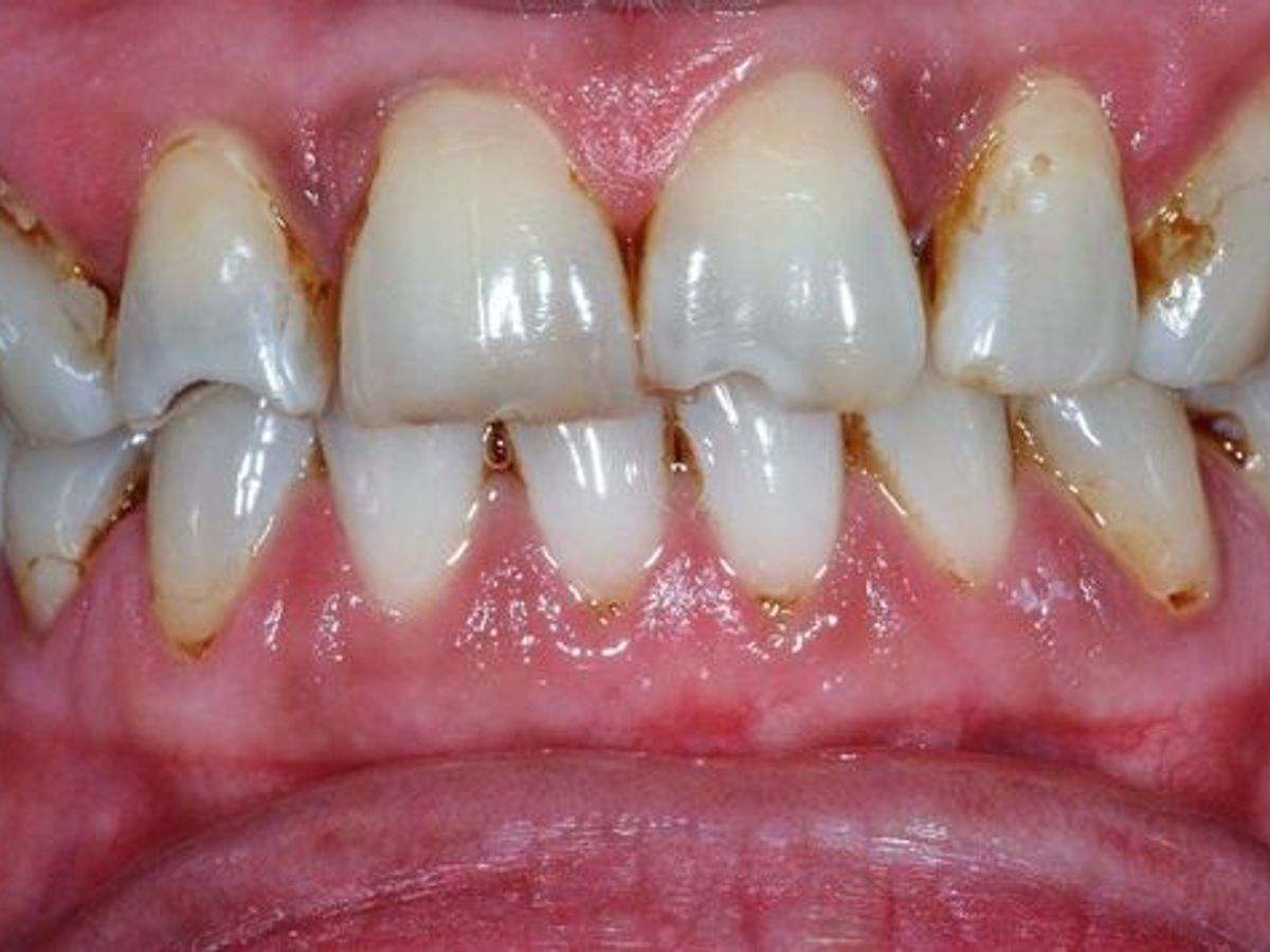 Veneers: Case 12 — before