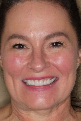 Dental Crowns: Case 35 — after
