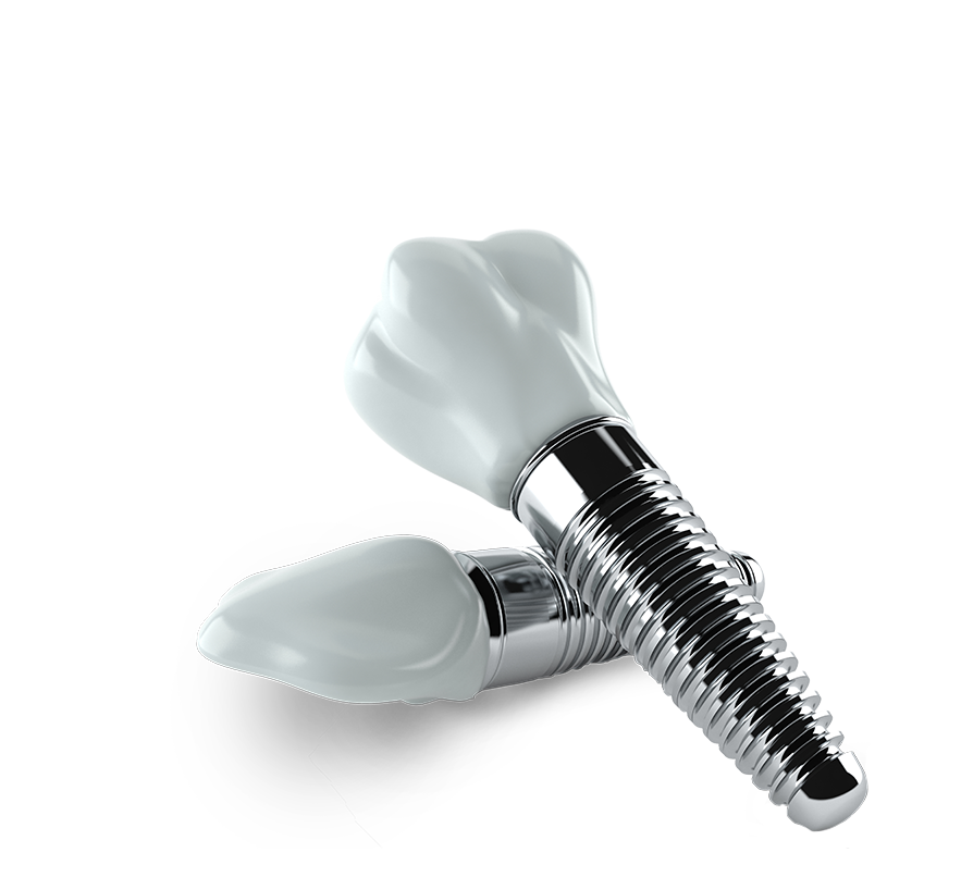 dental implants