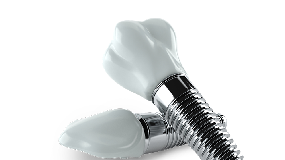 dental implants