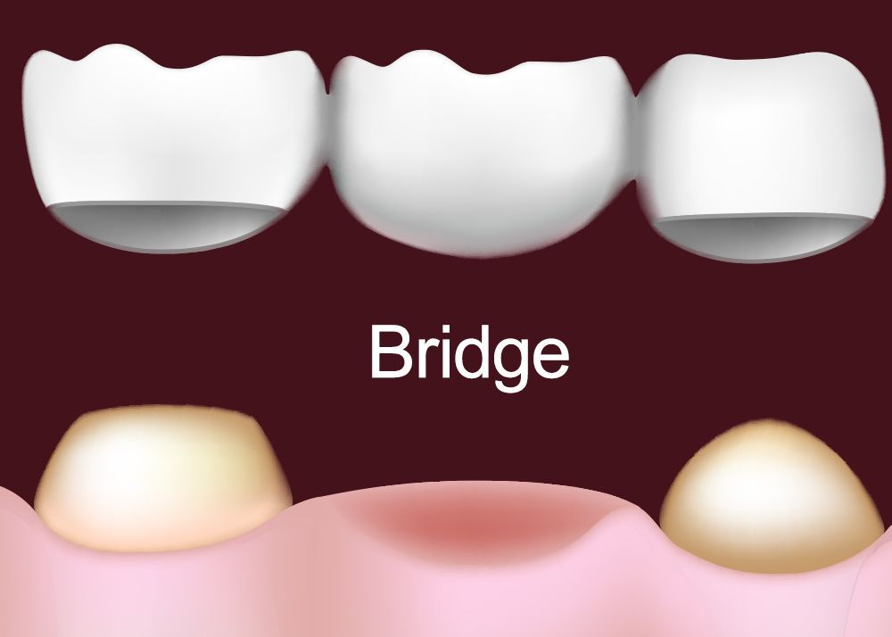 Dental Bridge Candidates