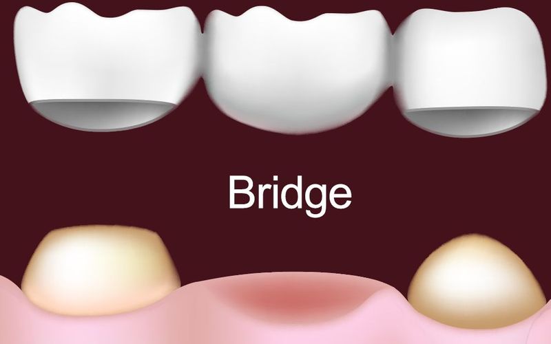 Dental Bridge Candidates