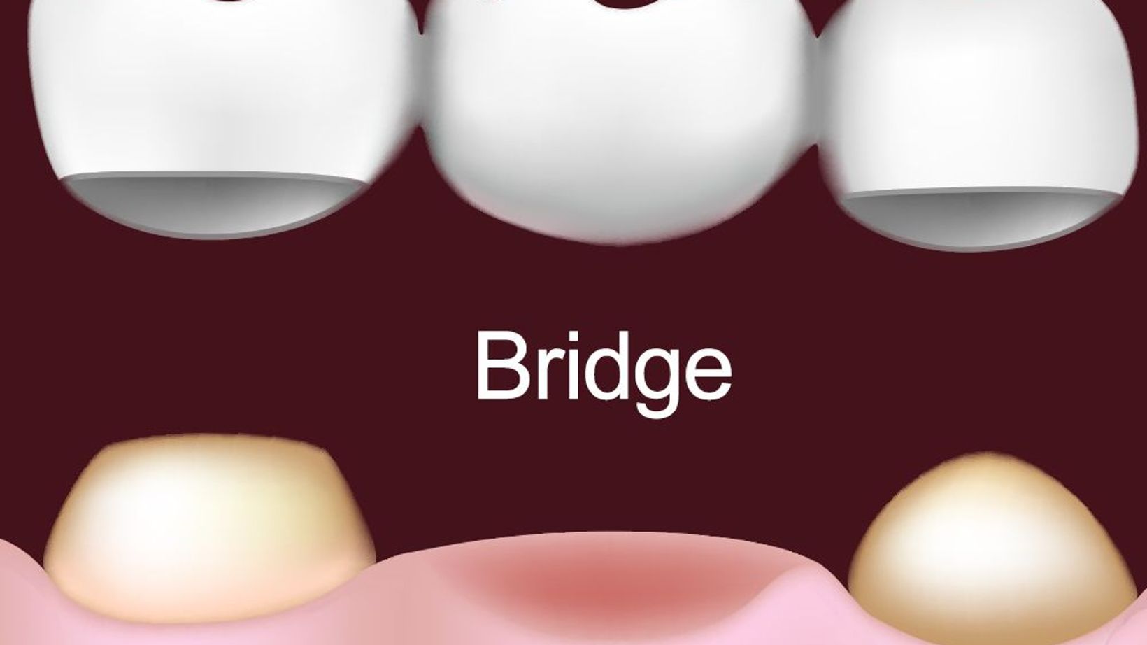 Dental Bridge Candidates