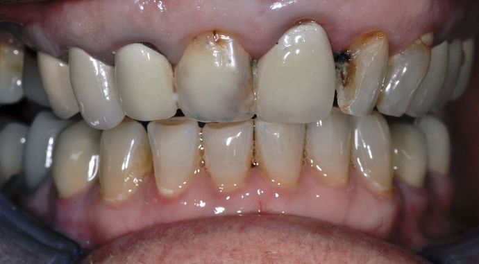 Dental Crowns: Case 22 — before