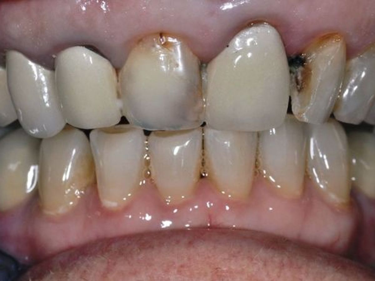Dental Crowns: Case 22 — before