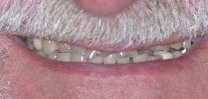 Dental Crowns: Case 25 — before