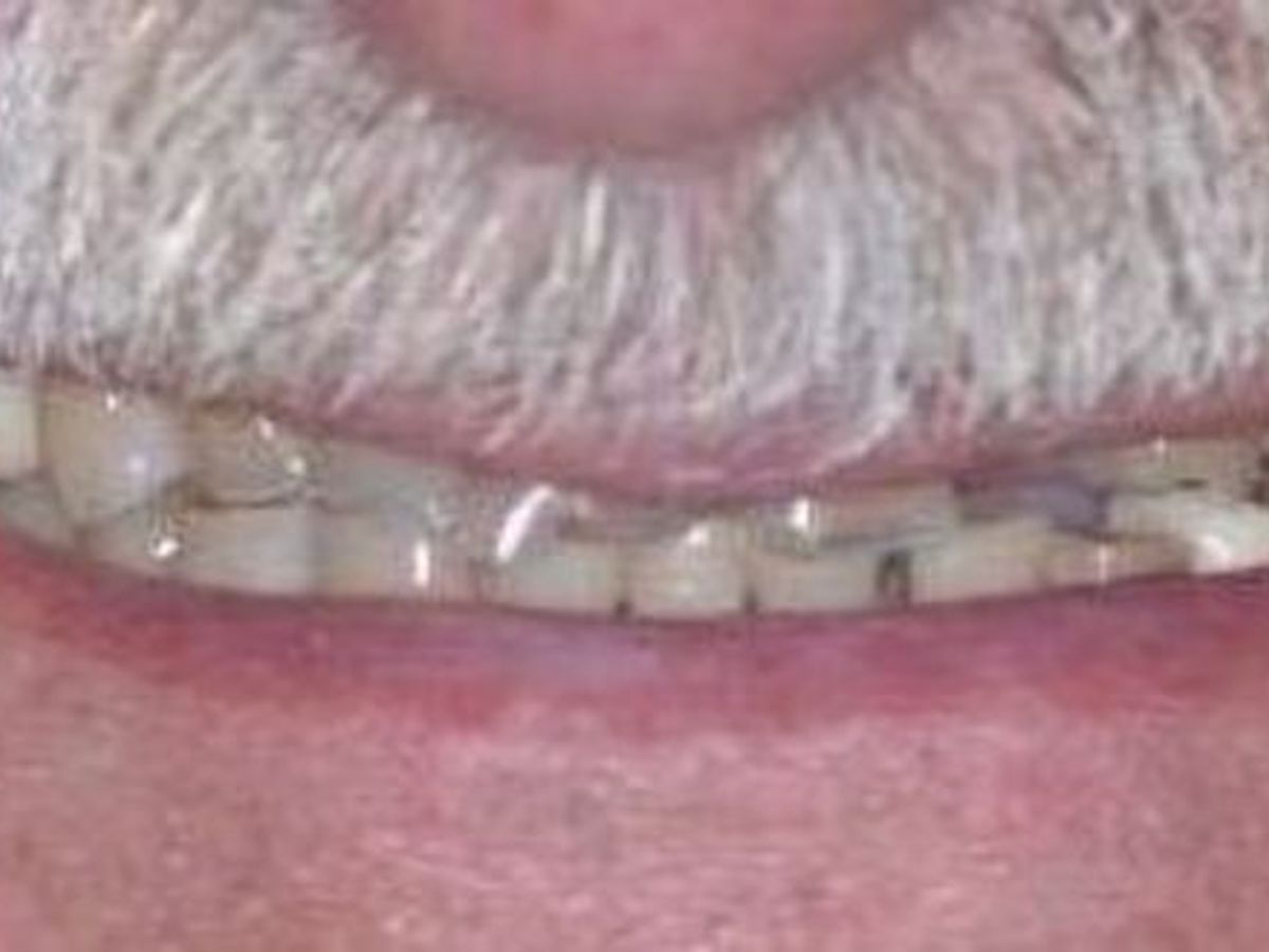 Dental Crowns: Case 25 — before
