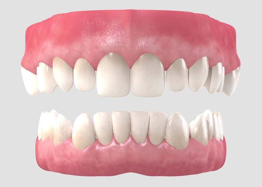 Enjoy the Benefits of Dentures in a Day
