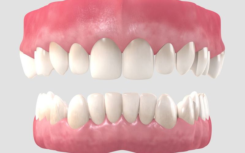 Enjoy the Benefits of Dentures in a Day