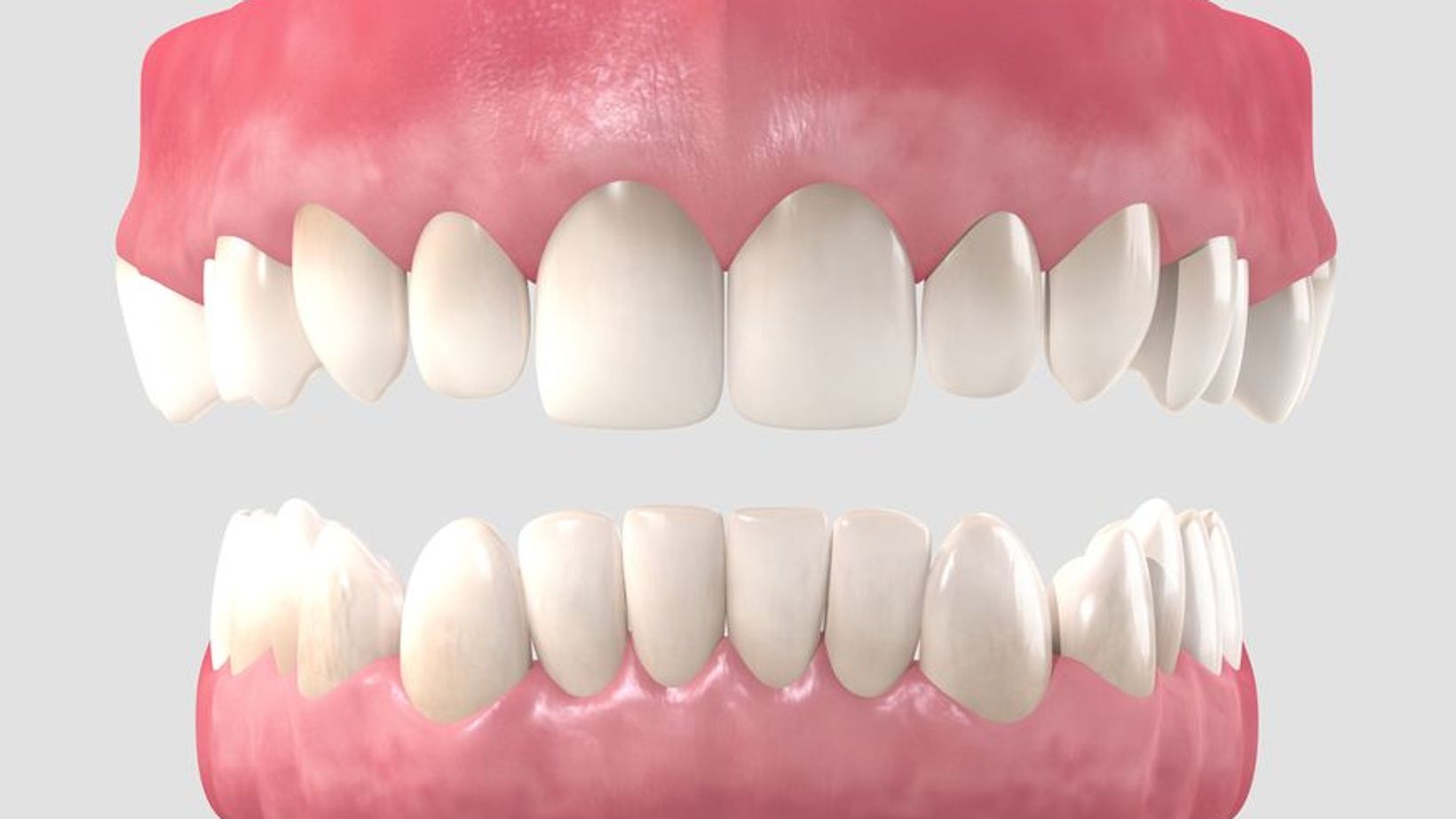 Enjoy the Benefits of Dentures in a Day