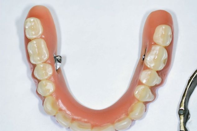 Teeth in a Day: Case 14 — Upper Arch / Restoration after
