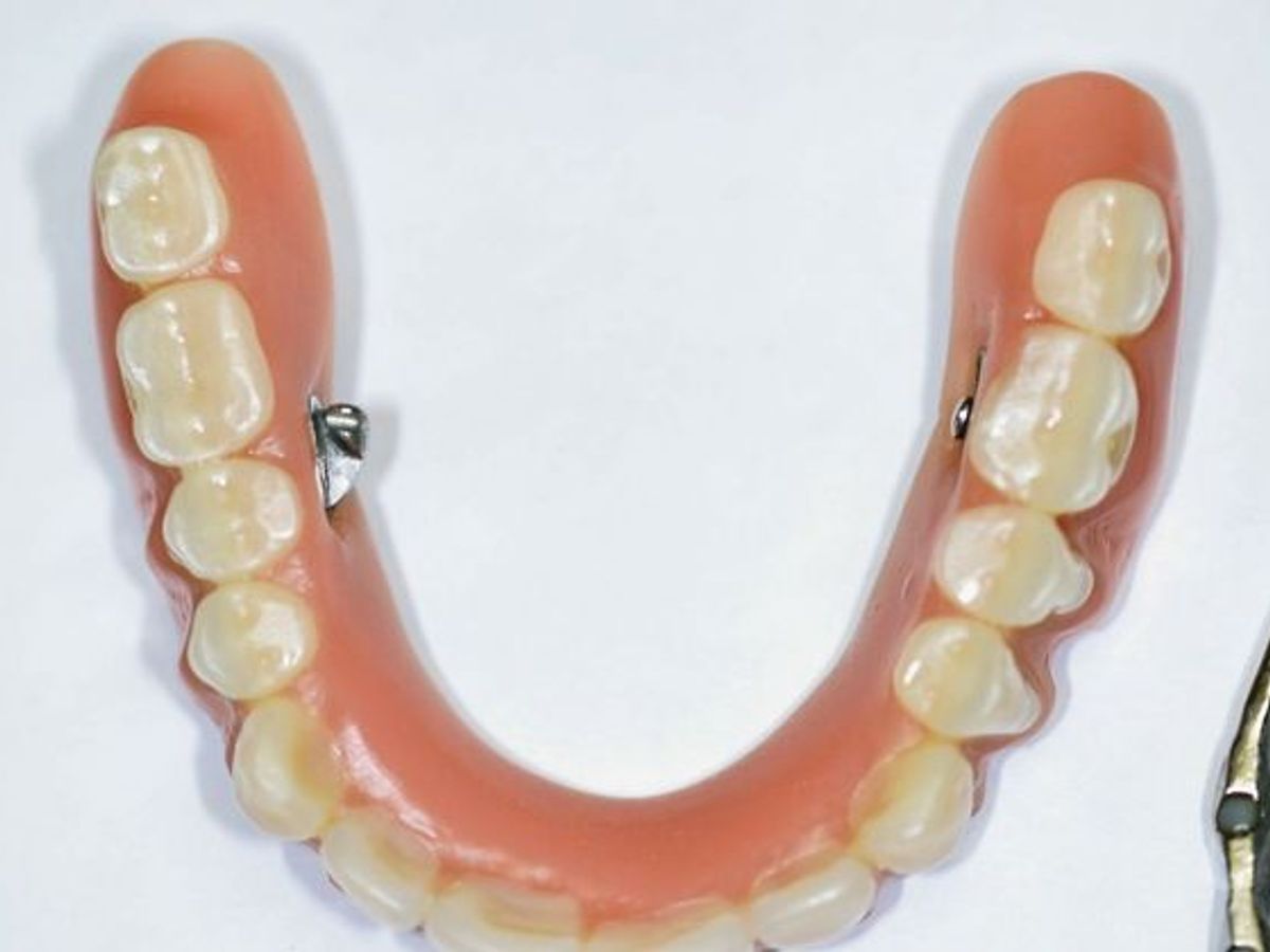 Teeth in a Day: Case 14 — Upper Arch / Restoration after