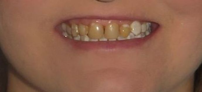 Dental Crowns: Case 17 — before