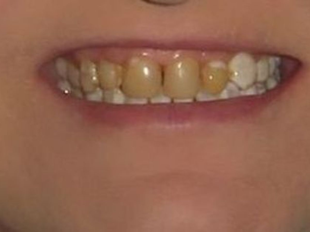 Dental Crowns: Case 17 — before