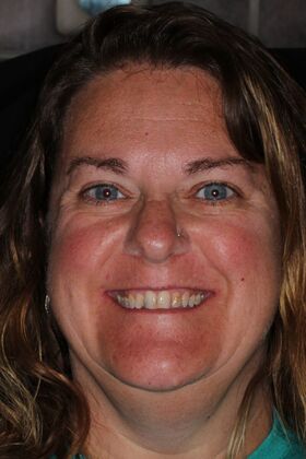 Veneers: Case 30 — before