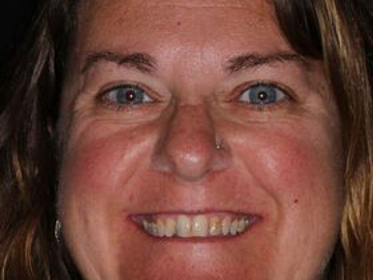Veneers: Case 30 — before