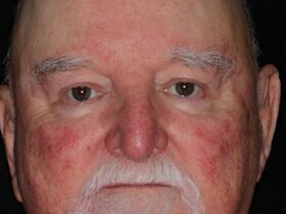 Dentures: Case 18 — before