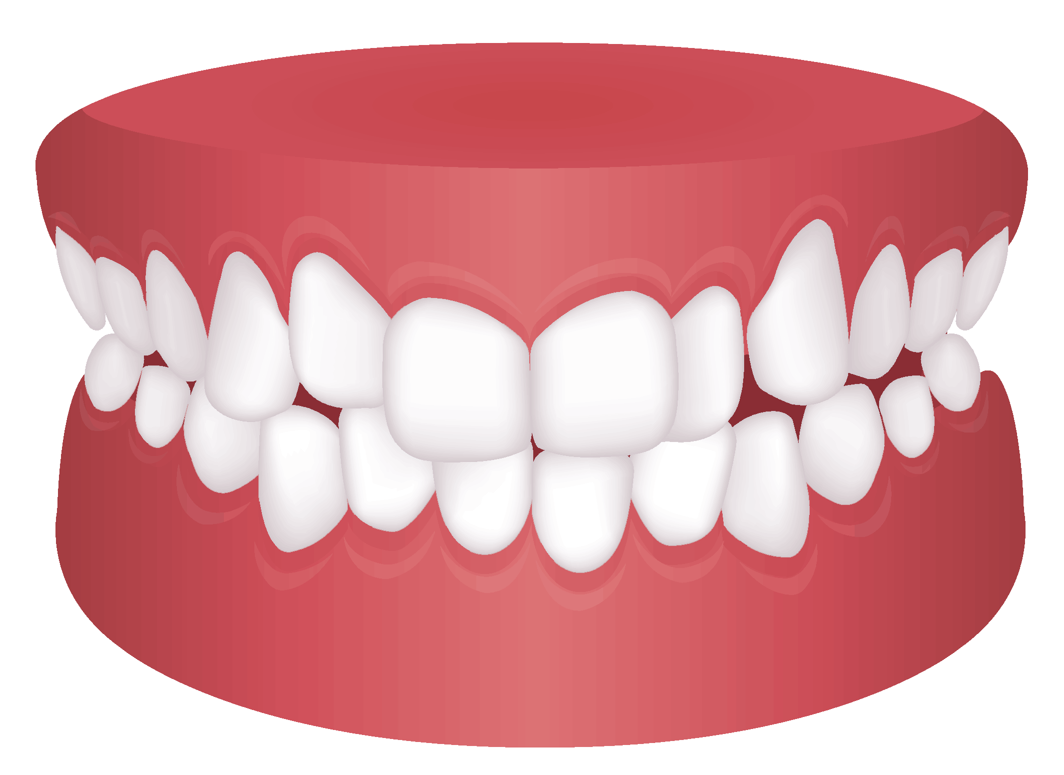 model of overcrowding teeth
