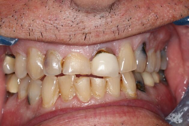 Full Mouth Reconstruction: Case 11 — before