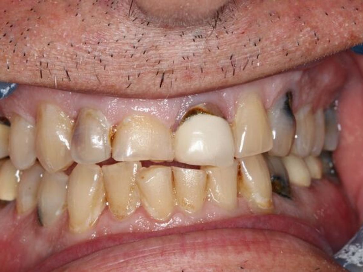Full Mouth Reconstruction: Case 11 — before