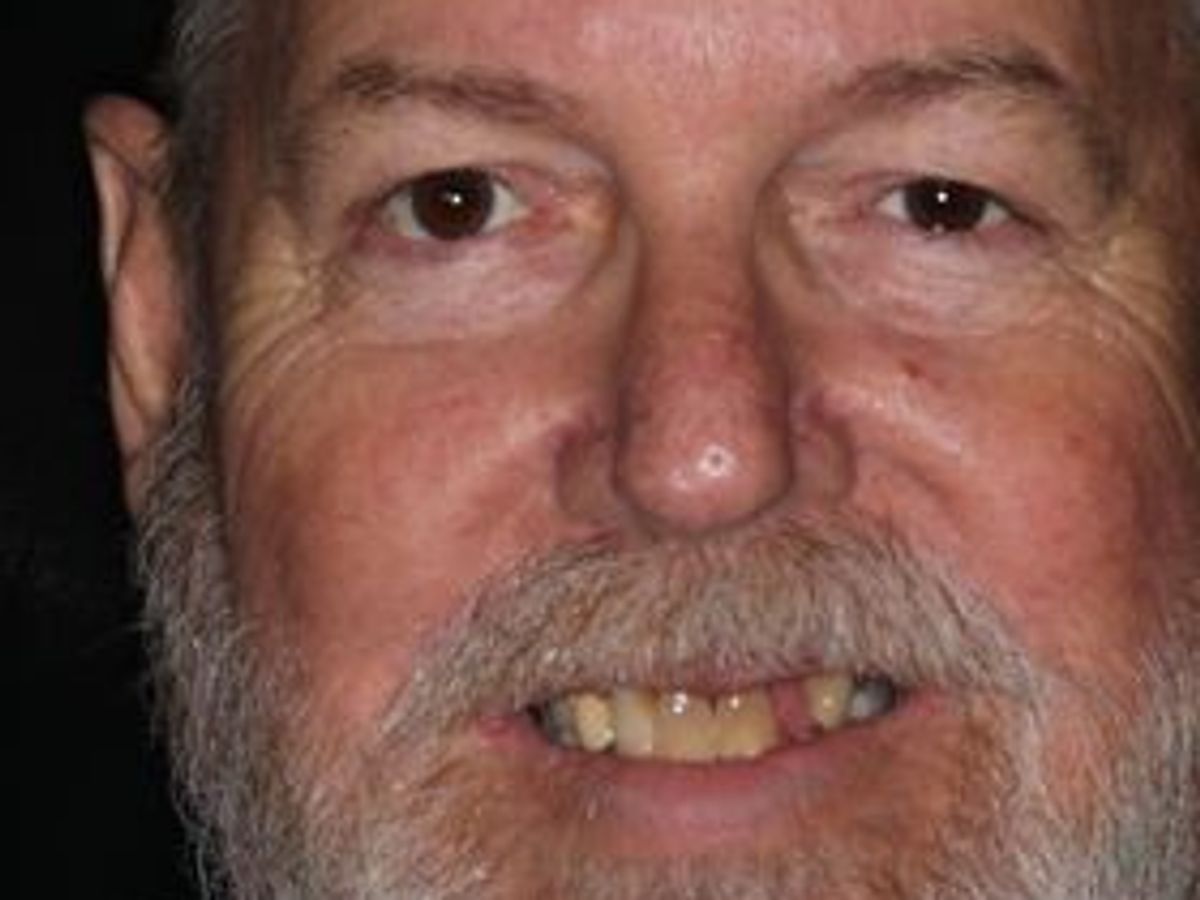 Dental Implants: Case 8 — before