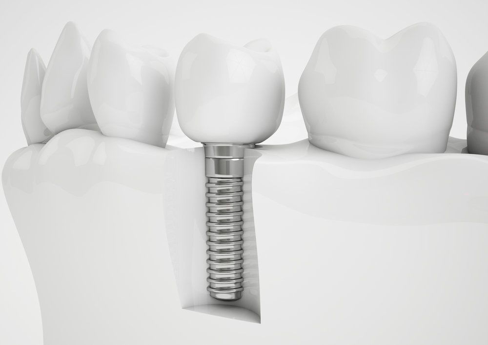 Dental Implants and Bone Grafting