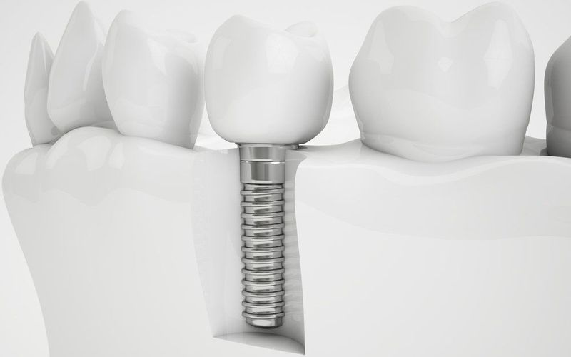 Dental Implants and Bone Grafting
