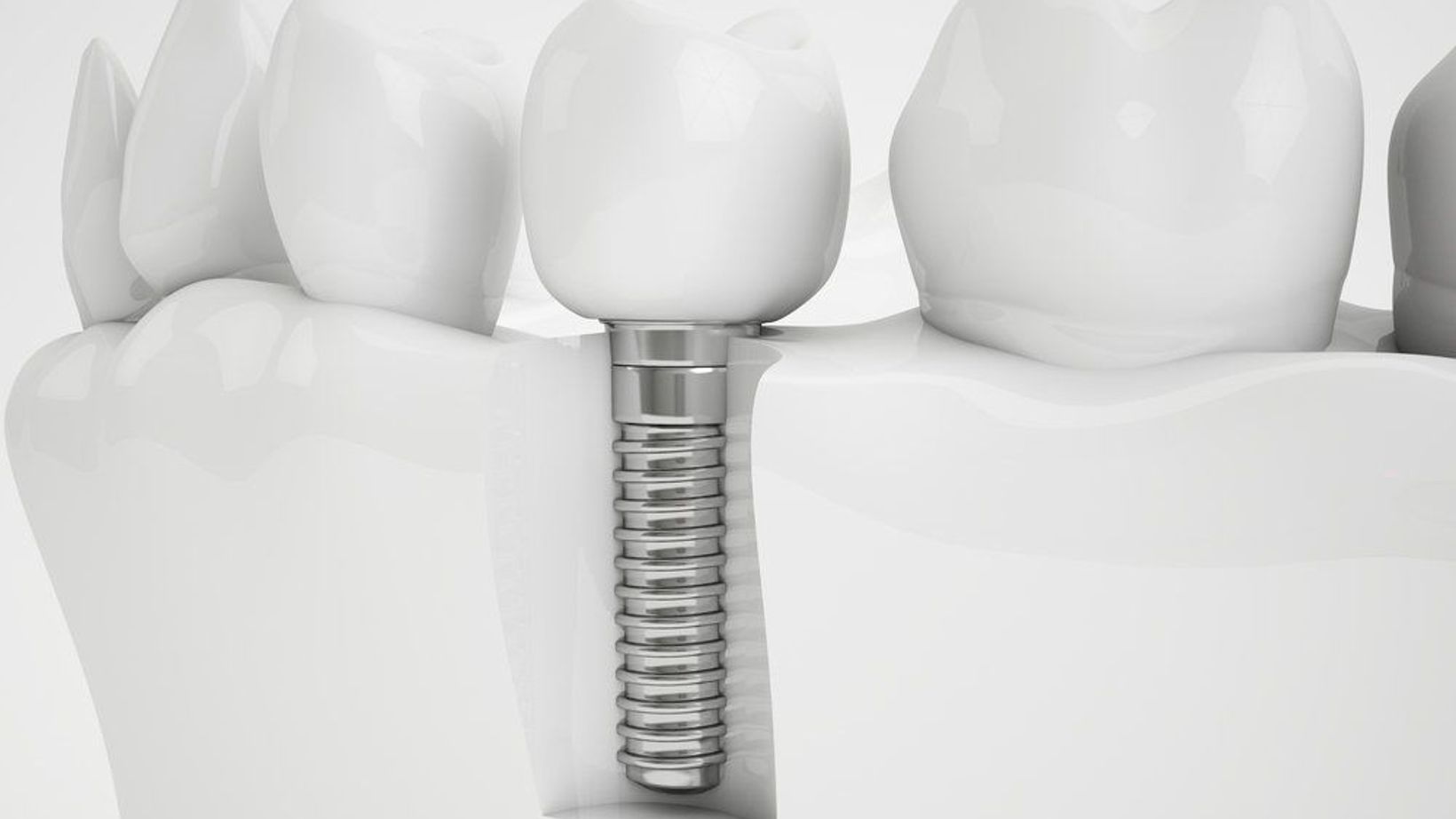 Dental Implants and Bone Grafting