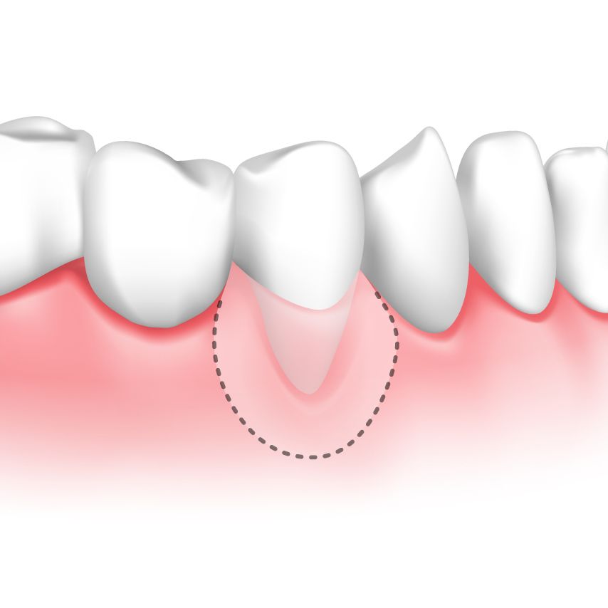 The Consequences of Gum Disease: Tooth Sensitivity and Exposed Roots