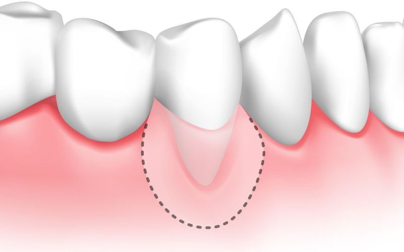 The Consequences of Gum Disease: Tooth Sensitivity and Exposed Roots