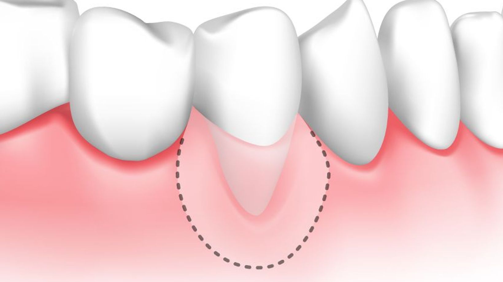 The Consequences of Gum Disease: Tooth Sensitivity and Exposed Roots