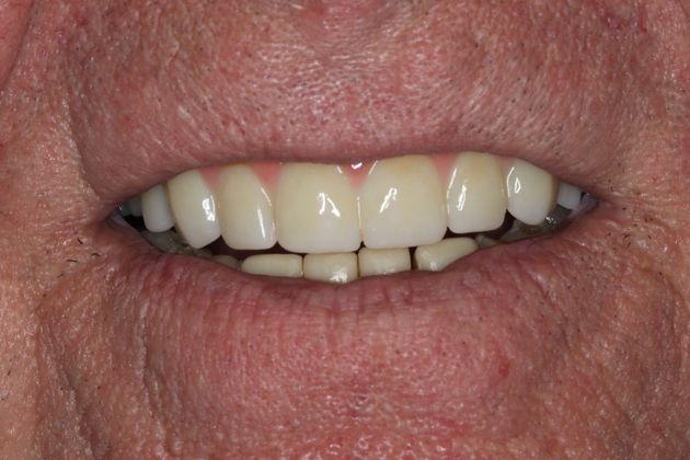 Teeth in a Day: Case 2 — Upper Arch before