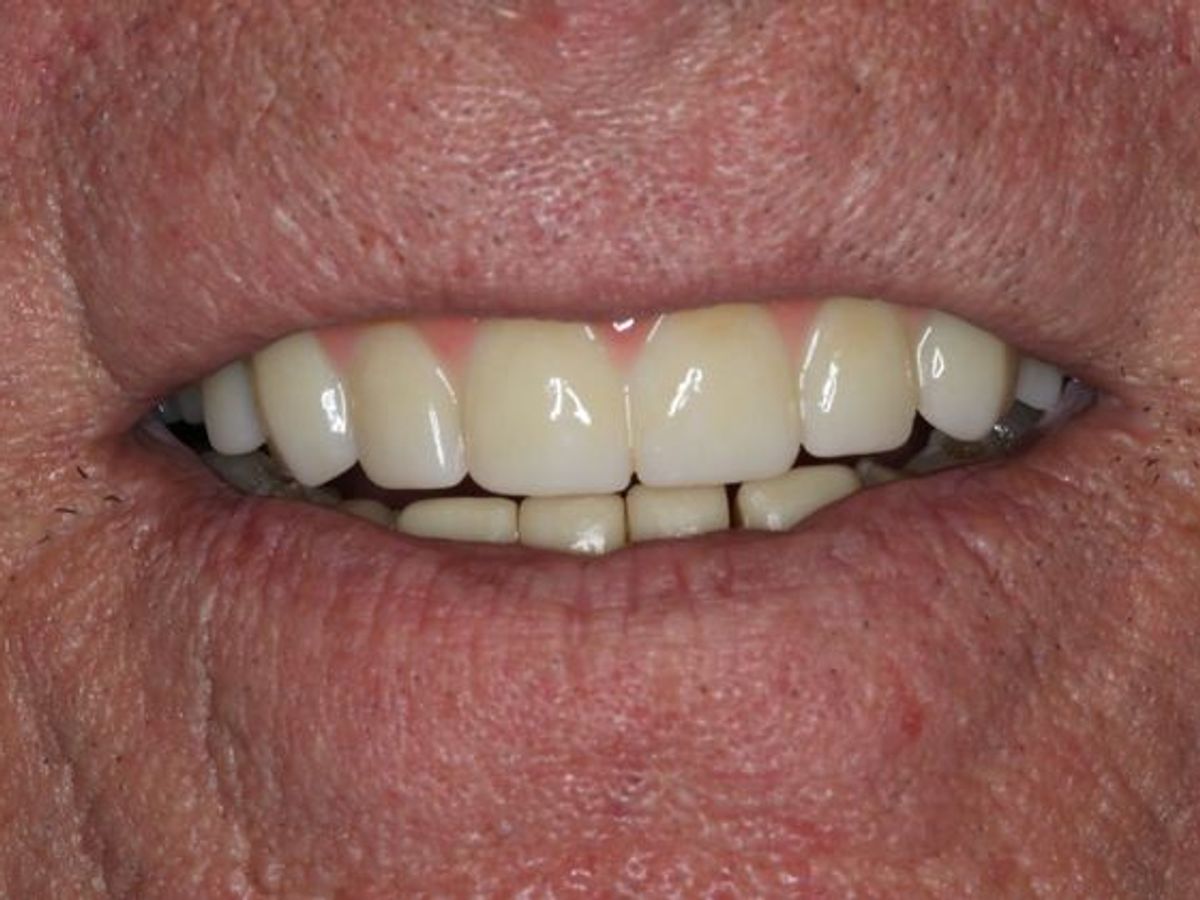 Teeth in a Day: Case 2 — Upper Arch before