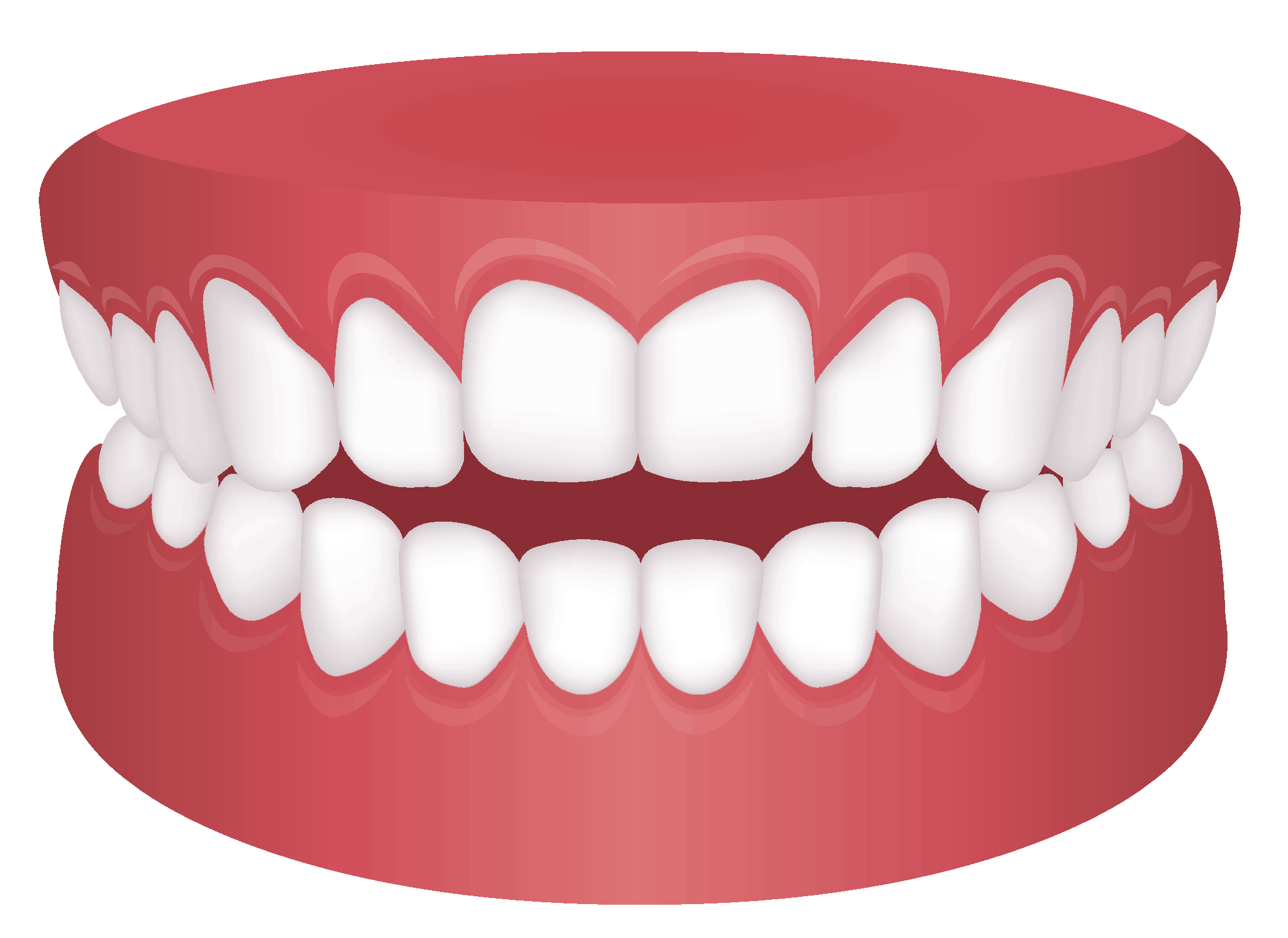 Open Bite diagram