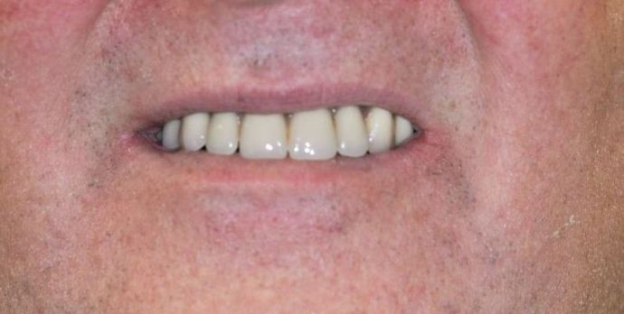 Teeth in a Day: Case 13 — Upper Arch before