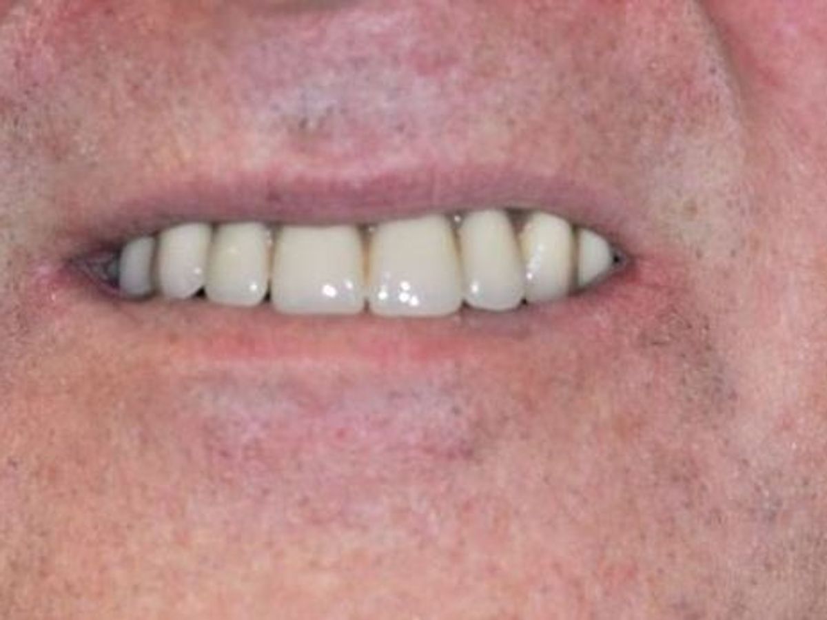 Teeth in a Day: Case 13 — Upper Arch before