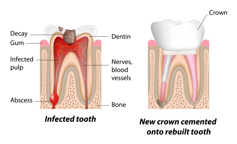 Root Canal Recovery