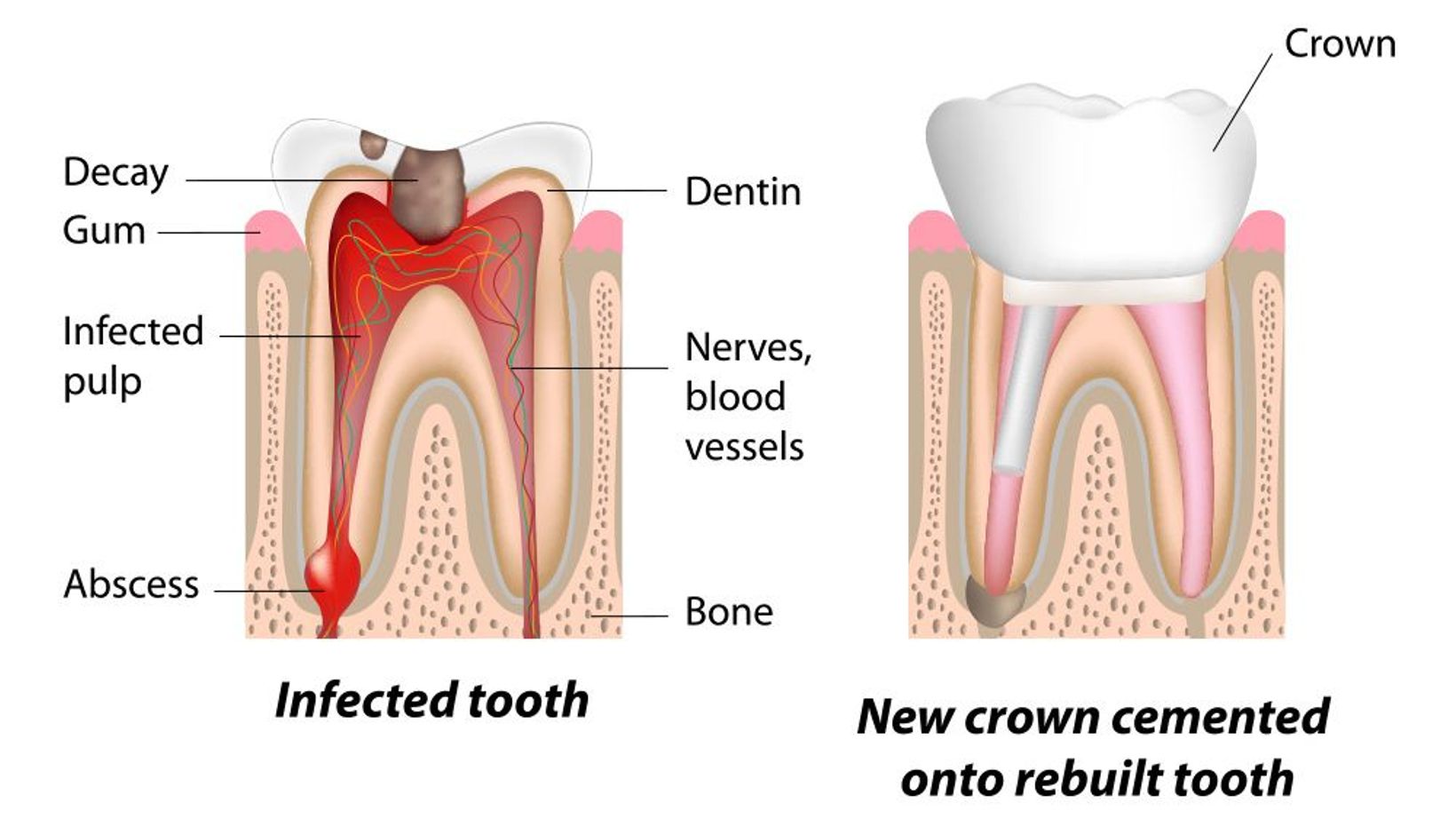 Root Canal Recovery