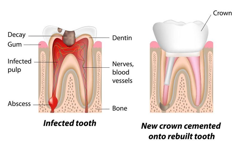 Root Canal Recovery