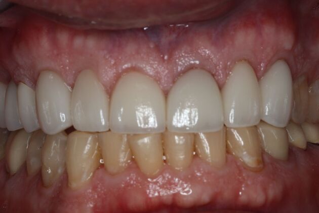 Full Mouth Reconstruction: Case 11 — after