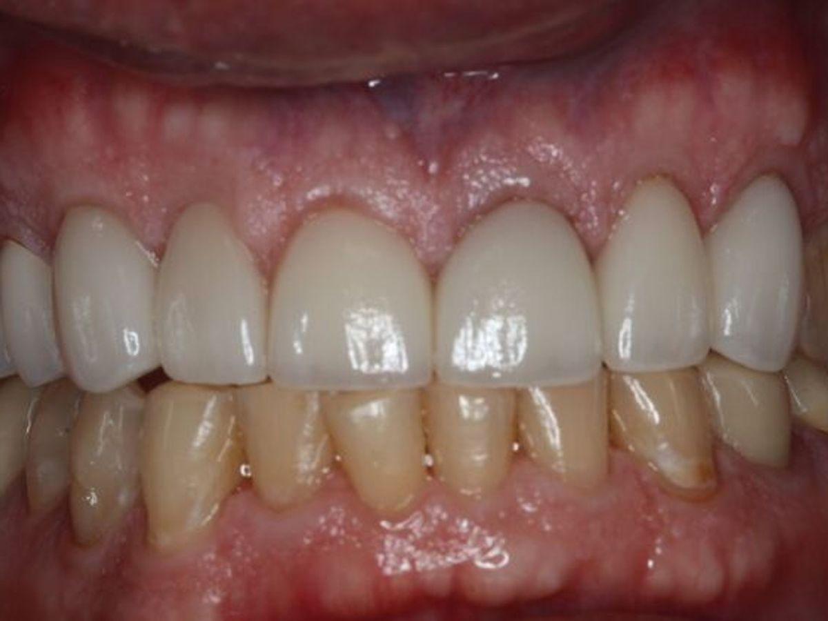 Full Mouth Reconstruction: Case 11 — after
