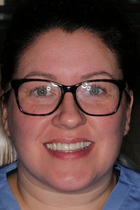 Veneers: Case 20 — after