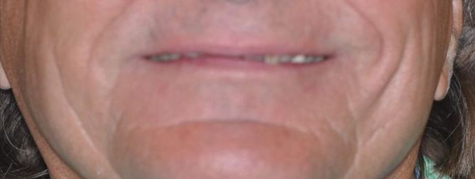 Dental Crowns: Case 12 — before