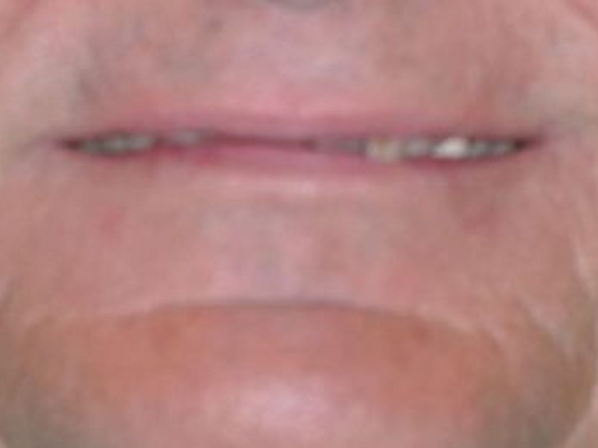 Dental Crowns: Case 12 — before
