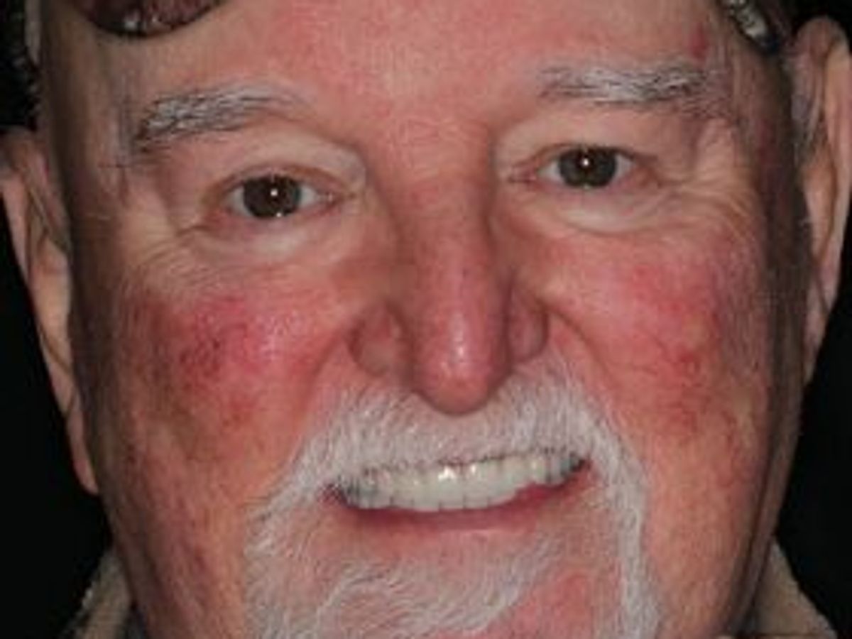 Dentures: Case 18 — after