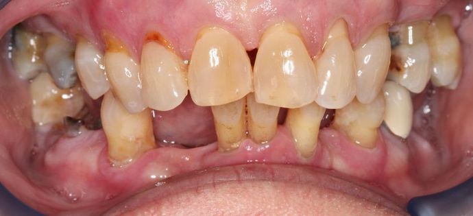 Teeth in a Day: Case 7 — before