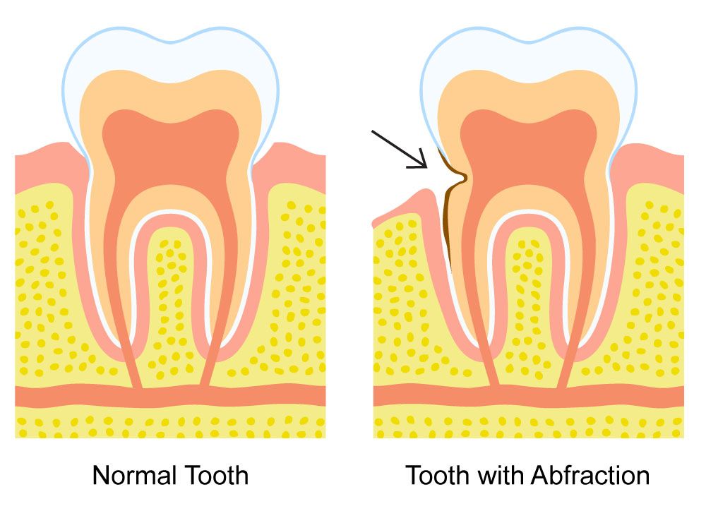 Dental Abfractions: What Are They and How Can You Protect Your Smile?