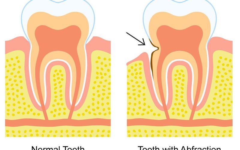 Dental Abfractions: What Are They and How Can You Protect Your Smile?